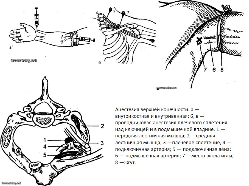 Анестезия верхней конечности. а — внутрикостная и внутривенная; 6, в — проводниковая анестезия плечевого